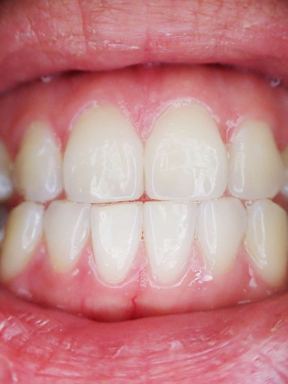 Why are my teeth yellow? COlorado SPrings Dental Hygiene. Dentist near me.